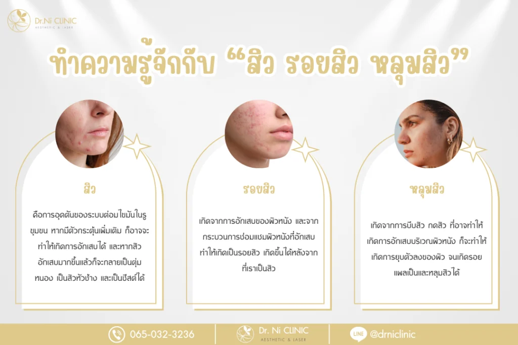 ทำความรู้จักกับ “สิว รอยสิว หลุมสิว”